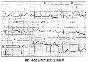 左束支傳導阻滯