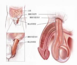 腹股溝直疝（疝氣）