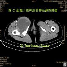 神經源性腫瘤