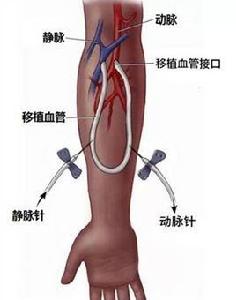 動靜脈內瘺