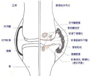 膝骨關節炎