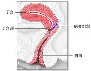 子宮息肉