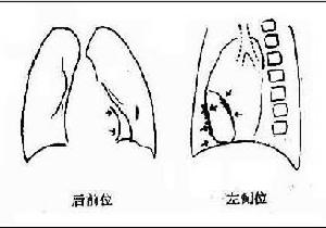 慢性縮窄性心包炎