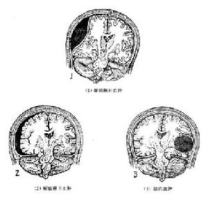 持續性植物狀態