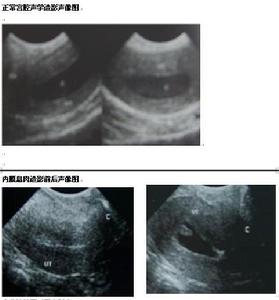 宮腔積膿