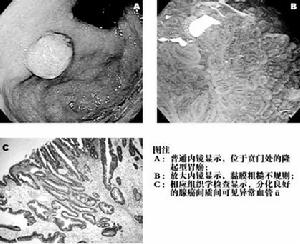 胃平滑肌肉瘤