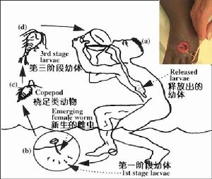 麥地那線蟲病病史