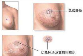 乳房包塊切除術