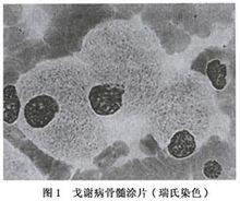 患者骨髓里的戈謝細胞