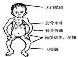 肋骨及胸骨下吸入性凹陷