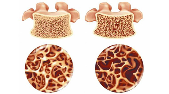 骨質疏鬆