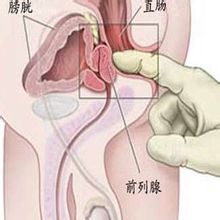 前列腺囊腫