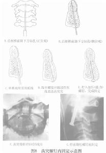 （圖）上頸椎不穩症