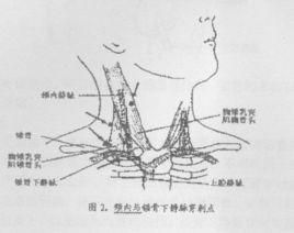 中心靜脈臨時導管置管術