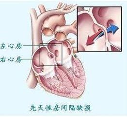 小兒房間隔缺損