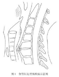 食管壓迫型頸椎病