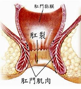 肛裂