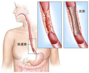 食管癌 