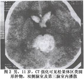 （圖）兒童松果體區腫瘤