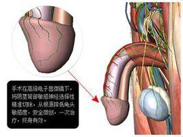 歐式陰莖敏感神經阻斷術