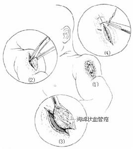 腦內海綿狀血管瘤