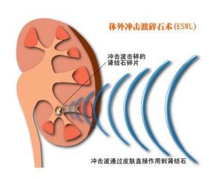 體外震波碎石術