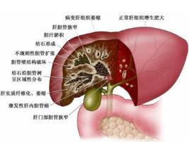 肝內膽管探查術