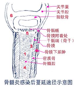 化膿性顱骨骨髓炎