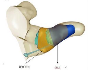 納米超隱形助聽器