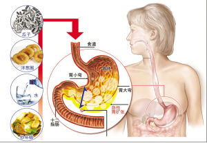 急性胃擴張