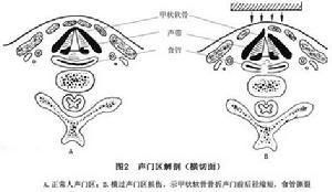 喉部鈍挫傷