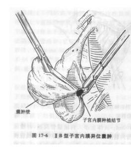 子宮內膜異位囊腫