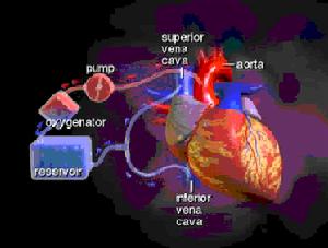 人工心肺機