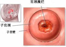 宮頸疾病