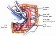 示意圖1:剪開縱隔胸膜