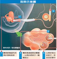 捐卵