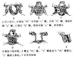 唇珠成形術