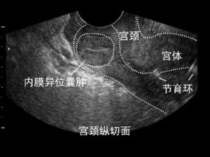 宮頸縱切面