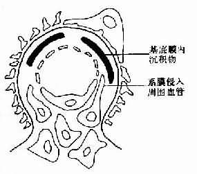 （圖）妊娠合併急性腎小球腎炎