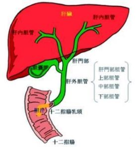 膽管炎