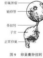 卵巢囊腫蒂扭轉