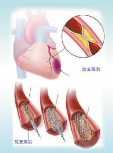 心臟支架手術