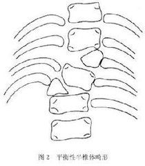半椎體畸形