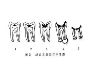 三度齲齒