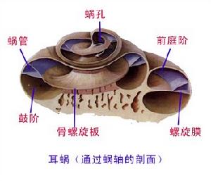 （圖）先天性耳蝸畸形