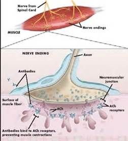 神經肌肉接頭疾病