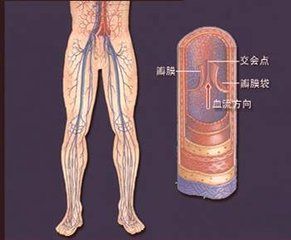 下肢靜脈瓣膜關閉不全