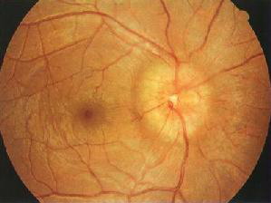 視盤水腫