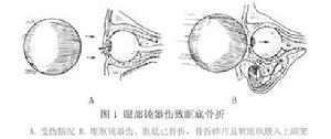 爆裂性眼眶骨折