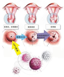 宮頸性白斑